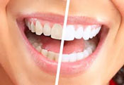 Whitening teeth Miami FL